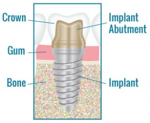 Dental Implant Illustration