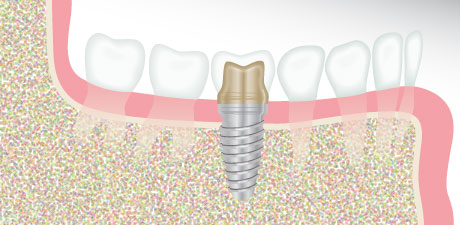 Dental Implant Illustration